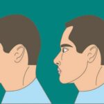 矫正孩子“地包天”越早越好