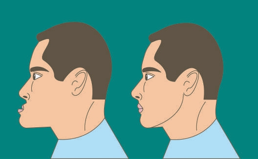 矫正孩子“地包天”越早越好
