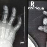 漂浮拇：成功保五指｜案例41：《让“漂浮拇”宝宝也能稳稳抓握》