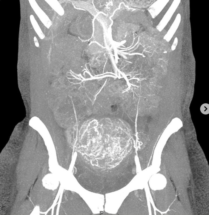 产后子宫血供丰富引关注